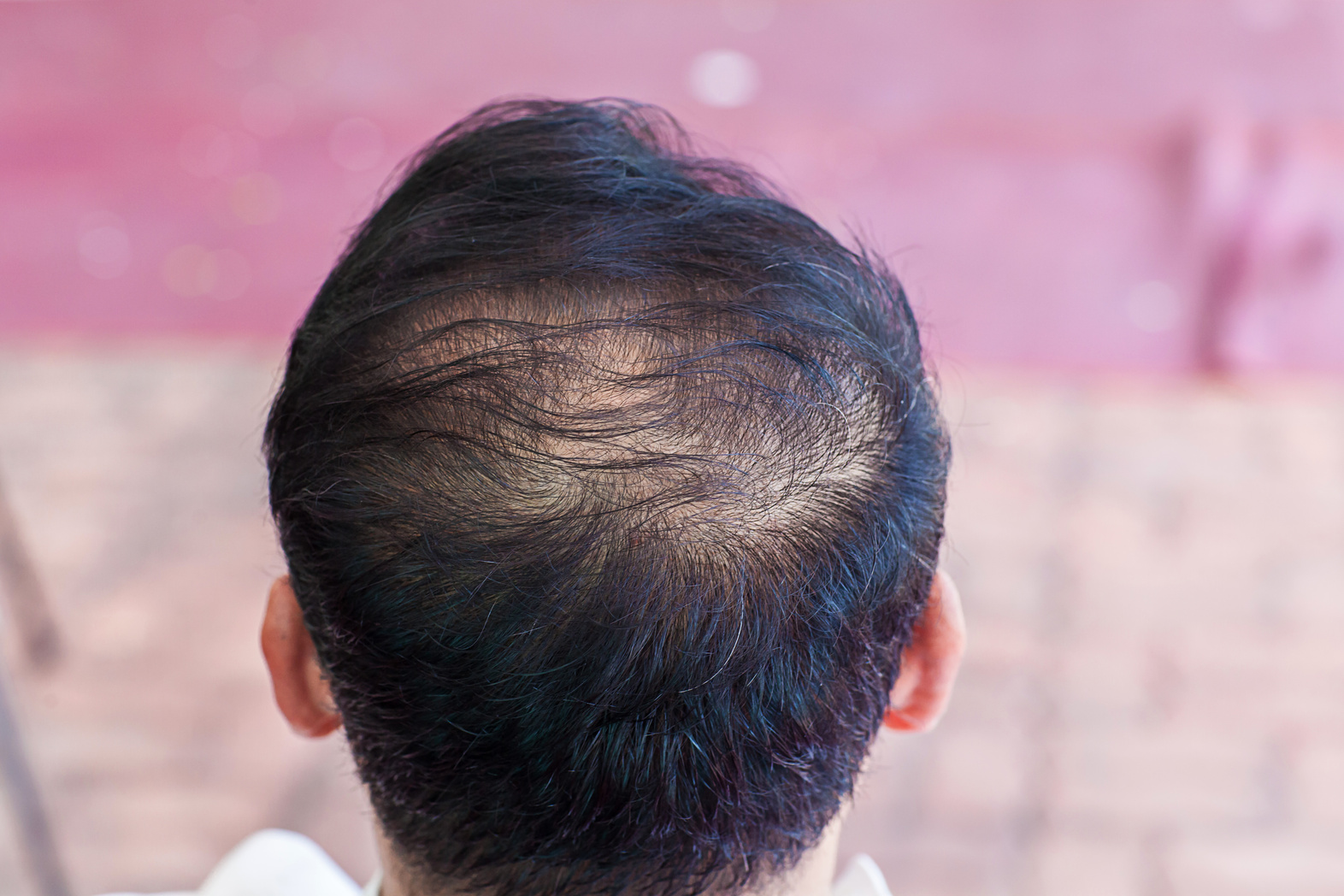 Close up hair loss, thinning hair and scalp issue. hair loss treatment.head with loss symptoms. Bald treatment.
